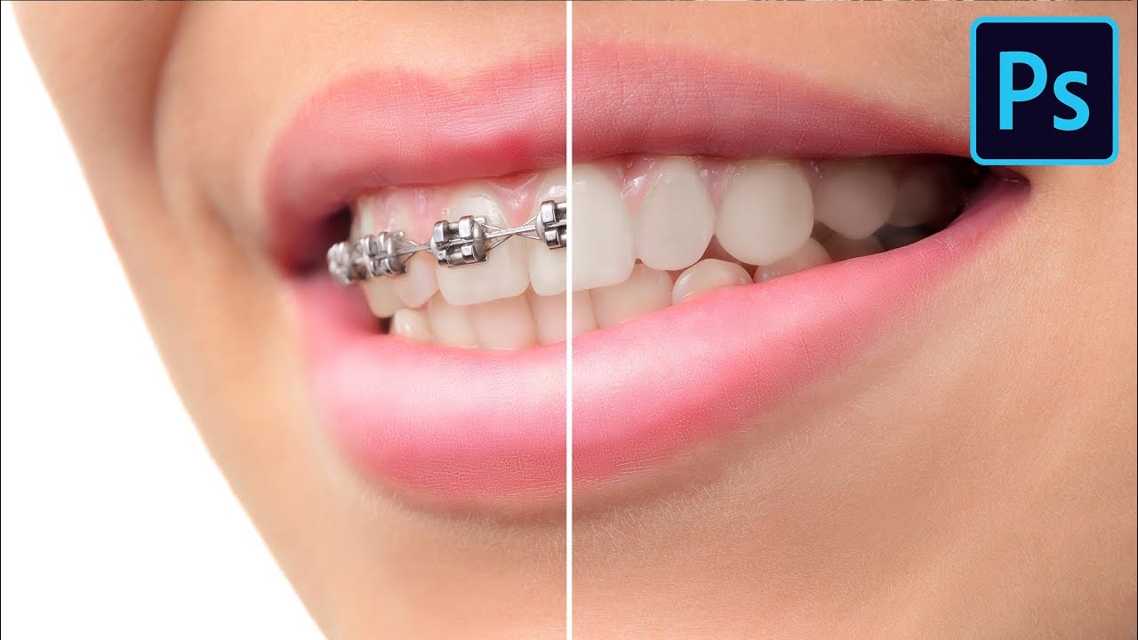 How to Remove Braces in Photoshop - LensVid.comLensVid.com